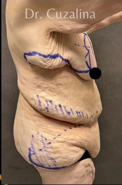 Before: Full Tummy Tuck | Lipo360 & Breast Reduction/Lift — profile · by Angelo Cuzalina, MD, DDS