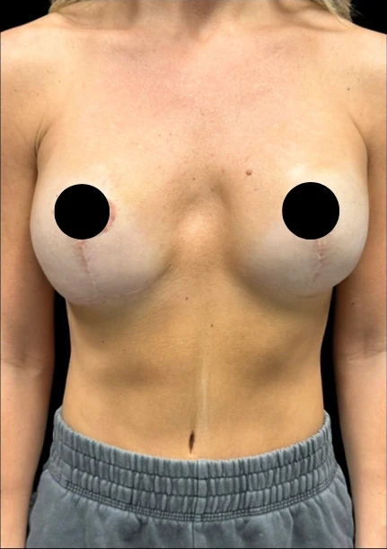 Before: Breast Augmentation — front · by Angelo Cuzalina, MD, DDS