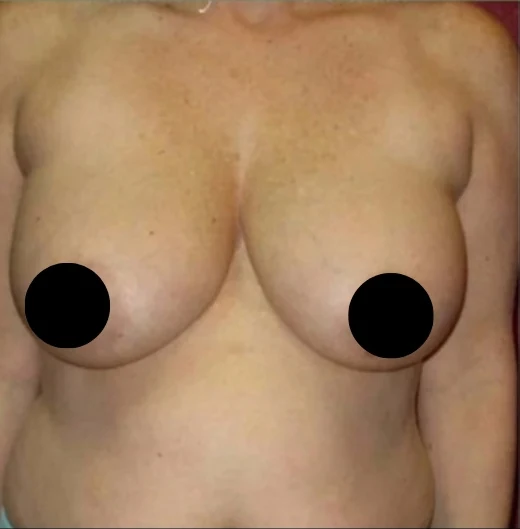 Before: Breast Reduction & Lift · by Angelo Cuzalina, MD, DDS