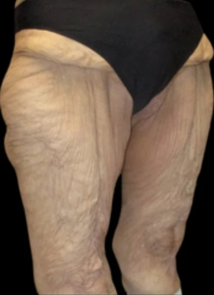 Before: Thigh & Knee Lift — back · by Angelo Cuzalina, MD, DDS