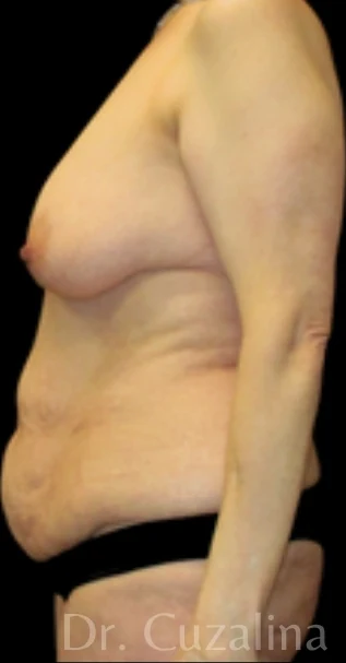 Before: Breast Lift w/out Implants, Full Tummy Tuck — profile · by Angelo Cuzalina, MD, DDS