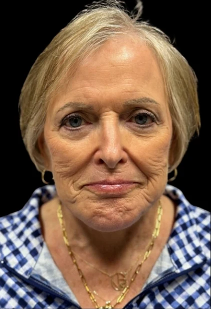 After: Lower Face & Neck Lift, Chin Implant — front · by Angelo Cuzalina, MD, DDS