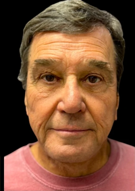 After: Lower Face & Neck Lift — front · by Angelo Cuzalina, MD, DDS