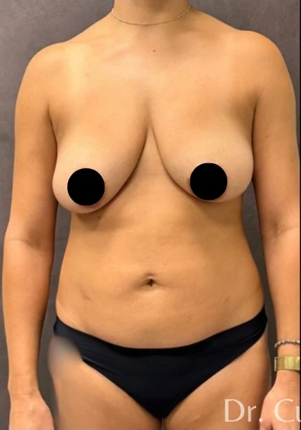 Before: Full Mommy Makeover (Breast Aug/Lift | Lipo 360 | Lipo to Hips & Thighs | Tummy Tuck | ... — front · by Angelo Cuzalina, MD, DDS