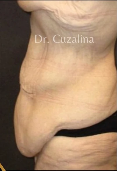 Before: Tummy Tuck / Excessive Skin Removal — oblique · by Angelo Cuzalina, MD, DDS