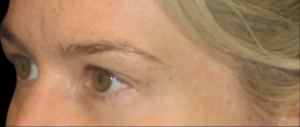 After: Upper Blepharoplasty — profile-closeup · by Carisa Champion, DO