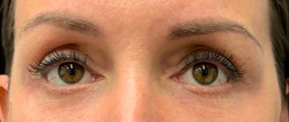 After: Lower Blepharoplasty · by Angelo Cuzalina, MD, DDS