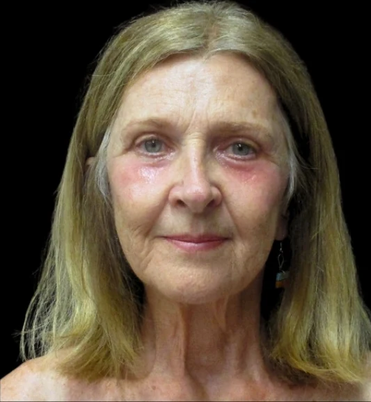 After: Upper/Lower Blephs & Laser Resurfacing — front · by Angelo Cuzalina, MD, DDS