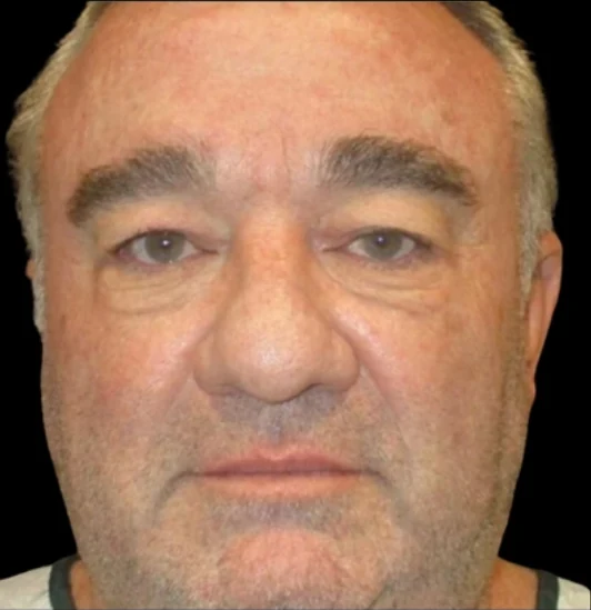 Before: Blepharoplasty · by Angelo Cuzalina, MD, DDS