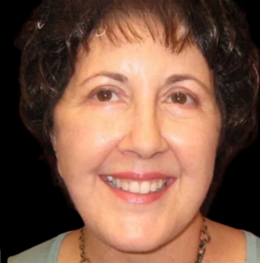 After: Blepharoplasty · by Angelo Cuzalina, MD, DDS