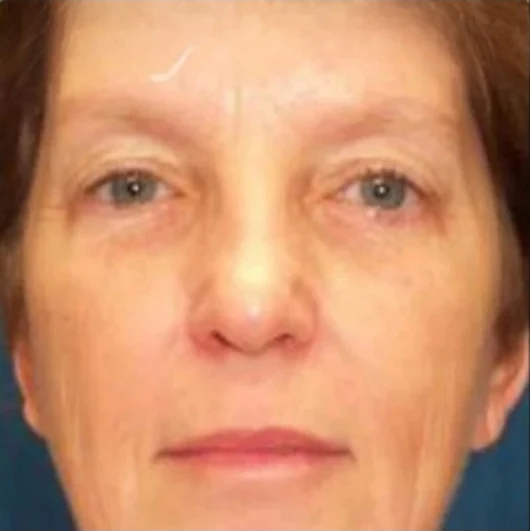 Before: Blepharoplasty · by Angelo Cuzalina, MD, DDS