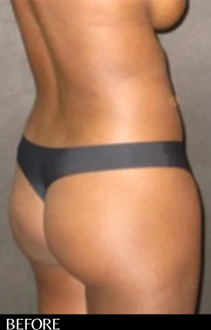 Before: Brazilian Butt Lift & Hidef Lipo — oblique-back · by Angelo Cuzalina, MD, DDS