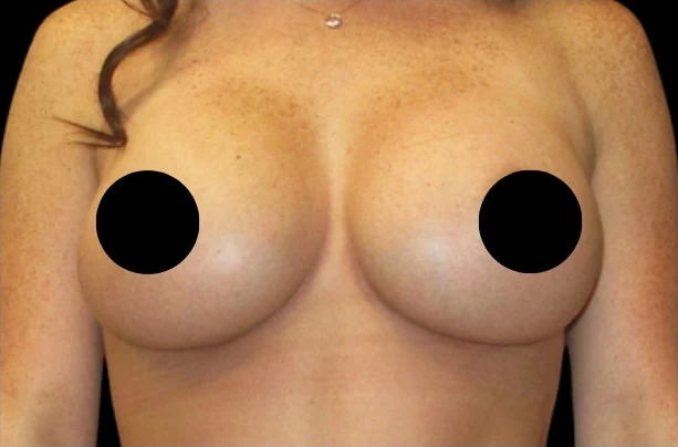 After: Breast Augmentation · by Angelo Cuzalina, MD, DDS