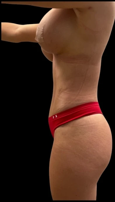 After: Breast Aug & Hidef Lipo — profile · by Pasquale Tolomeo, MD
