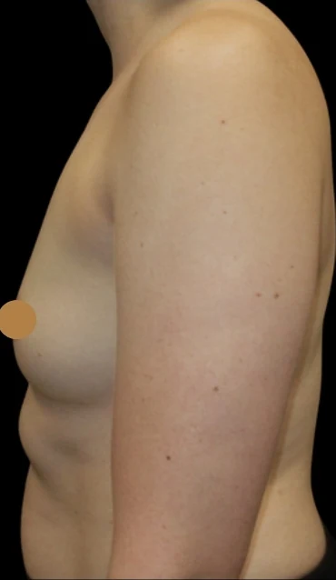 Before: Breast Augmentation — profile · by Angelo Cuzalina, MD, DDS