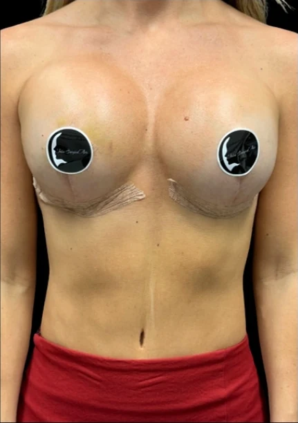 After: Breast Augmentation — front · by Angelo Cuzalina, MD, DDS