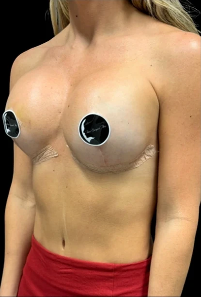 After: Breast Augmentation — three-quarter · by Angelo Cuzalina, MD, DDS