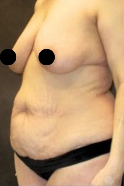 Before: Breast Lift w/out Implants, Full Tummy Tuck — oblique · by Angelo Cuzalina, MD, DDS