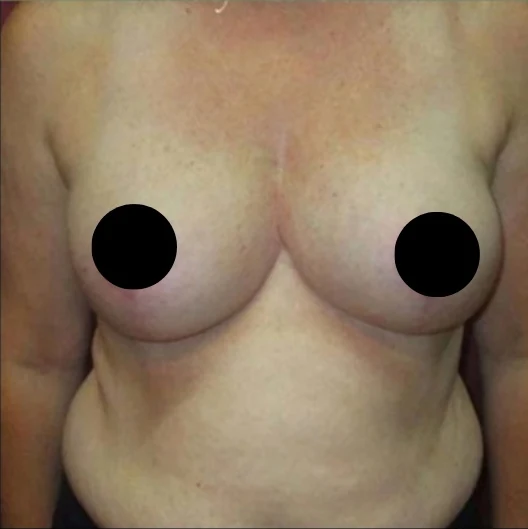 After: Breast Reduction & Lift · by Angelo Cuzalina, MD, DDS