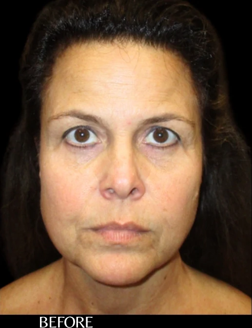 Before: Endoscopic Forehead & Brow Lift — front · by Angelo Cuzalina, MD, DDS