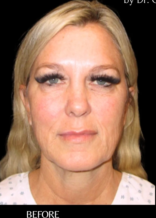 Before: Full Lower Face & Neck Lift, Endoscopic Forehead & Brow Lift, CO2 Laser Resurfacing — front · by Angelo Cuzalina, MD, DDS