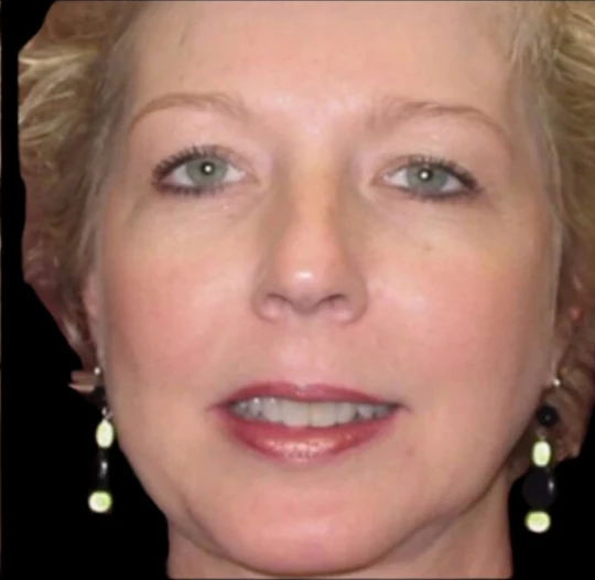 After: Chin Augmentation, Deep Plane Lower Face Lift — front · by Angelo Cuzalina, MD, DDS