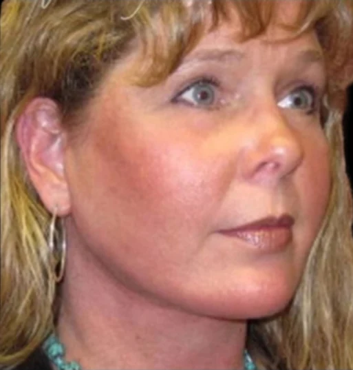 After: Blepharoplasty, Brow Lift, Lower Face & Neck Lift · by Angelo Cuzalina, MD, DDS