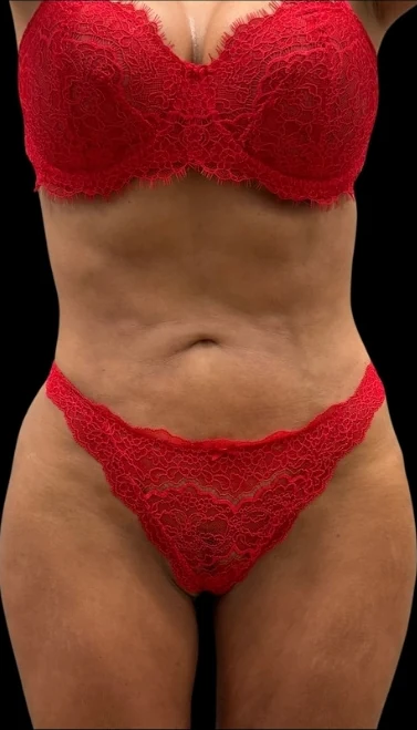 After: Hidef Lipo & Thigh Lipo w/ Vaser Renuvion — front · by Pasquale Tolomeo, MD