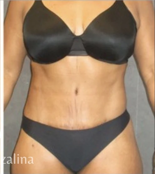 After: Tummy Tuck & Lipo to Waist & Hips — front · by Angelo Cuzalina, MD, DDS