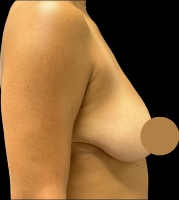 Before: Breast Aug/Lift · by Angelo Cuzalina, MD, DDS
