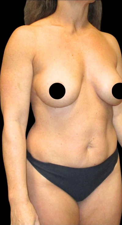 Before: Breast Aug/Lift, Tummy Tuck, Lipo360 — oblique · by Angelo Cuzalina, MD, DDS
