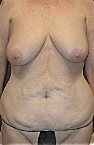 Before: Breast Augmentation/Lift & Tummy Tuck — front-torso · by Angelo Cuzalina, MD, DDS