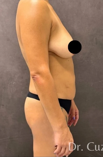 Before: Full Mommy Makeover (Breast Aug/Lift | Lipo 360 | Lipo to Hips & Thighs | Tummy Tuck | ... — profile · by Angelo Cuzalina, MD, DDS