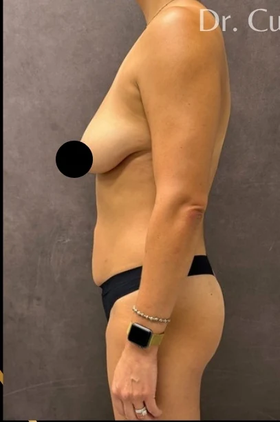 Before: Full Mommy Makeover (Breast Aug/Lift | Lipo 360 | Lipo to Hips & Thighs | Tummy Tuck | ... — profile · by Angelo Cuzalina, MD, DDS