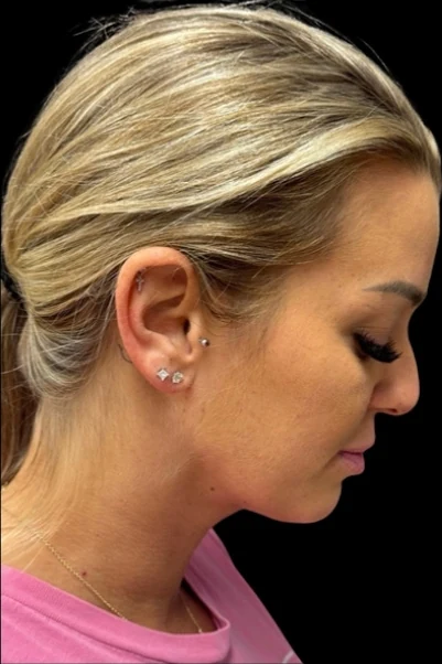 After: Neck Lipo — profile · by Carisa Champion, DO