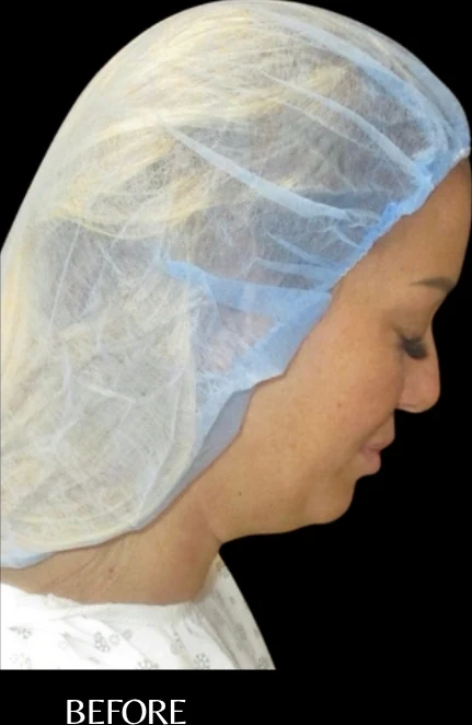 Before: Neck Lipo — profile · by Carisa Champion, DO