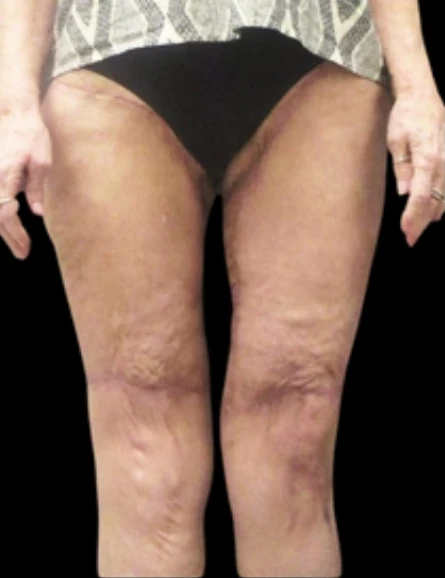 After: Thigh & Knee Lift — front · by Angelo Cuzalina, MD, DDS