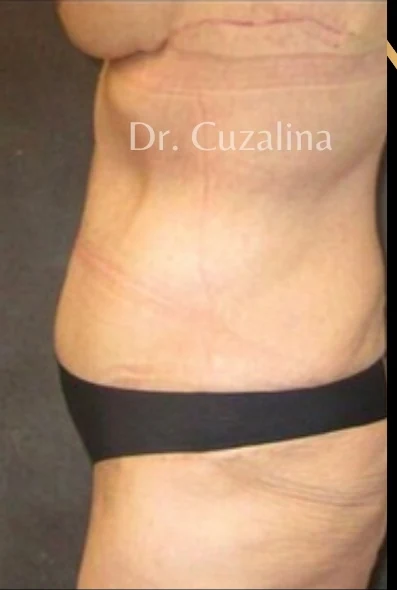 After: Tummy Tuck / Excessive Skin Removal — oblique · by Angelo Cuzalina, MD, DDS