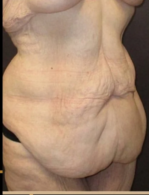 Before: Tummy Tuck / Excessive Skin Removal — three-quarter · by Angelo Cuzalina, MD, DDS