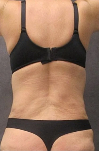 After: Tummy Tuck & Lipo 360 to Waist and Hips — back · by Angelo Cuzalina, MD, DDS