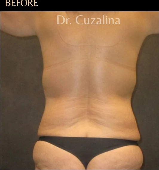 Before: Tummy Tuck & Lipo 360 — back · by Angelo Cuzalina, MD, DDS