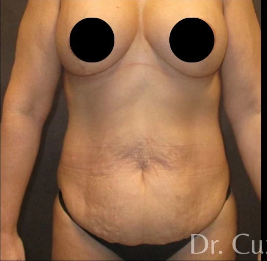 Before: Tummy Tuck & Lipo 360 — front · by Angelo Cuzalina, MD, DDS