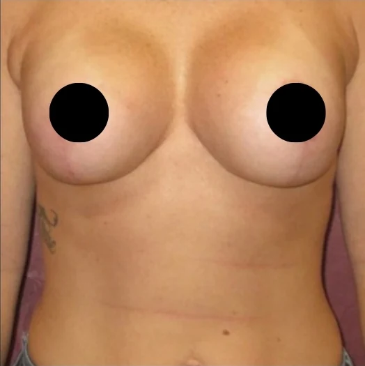 After: Breast Reduction & Lift · by Angelo Cuzalina, MD, DDS