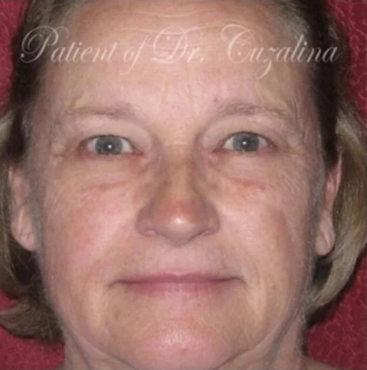 Before: Blepharoplasty, Laser Skin Resurfacing, Brow Lift · by Angelo Cuzalina, MD, DDS
