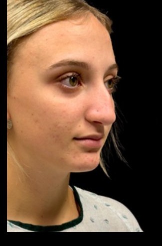 Before: Rhinoplasty — three-quarter · by Dr. Cuzalina