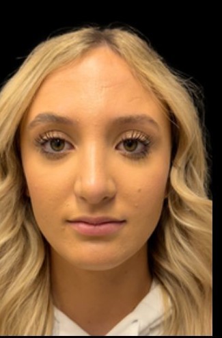 After: Rhinoplasty — front · by Dr. Cuzalina
