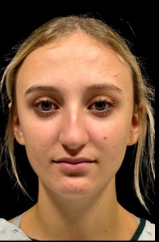 Before: Rhinoplasty — front · by Dr. Cuzalina