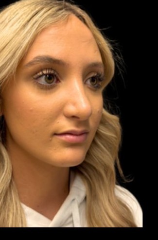 After: Rhinoplasty — three-quarter · by Dr. Cuzalina
