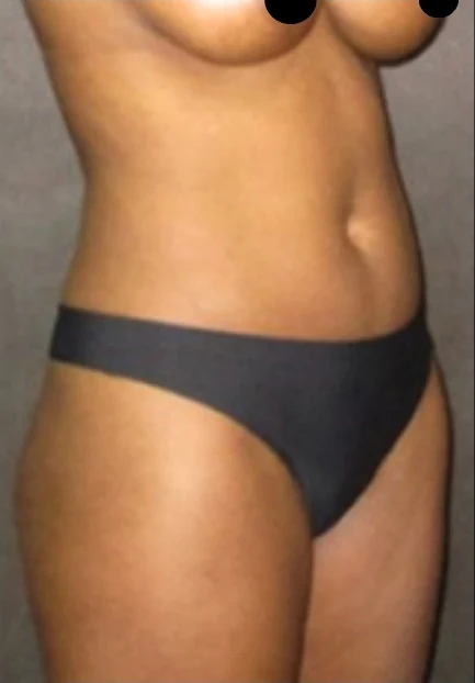 Before: Brazilian Butt Lift & Hidef Lipo — oblique · by Angelo Cuzalina, MD, DDS