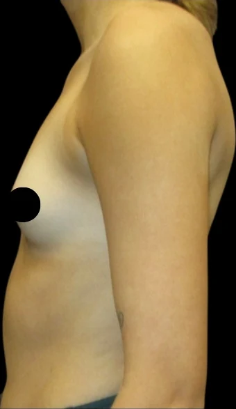 Before: Breast Augmentation — profile · by Carisa Champion, DO